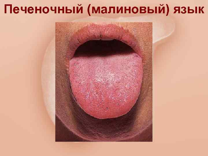 Печеночный (малиновый) язык 