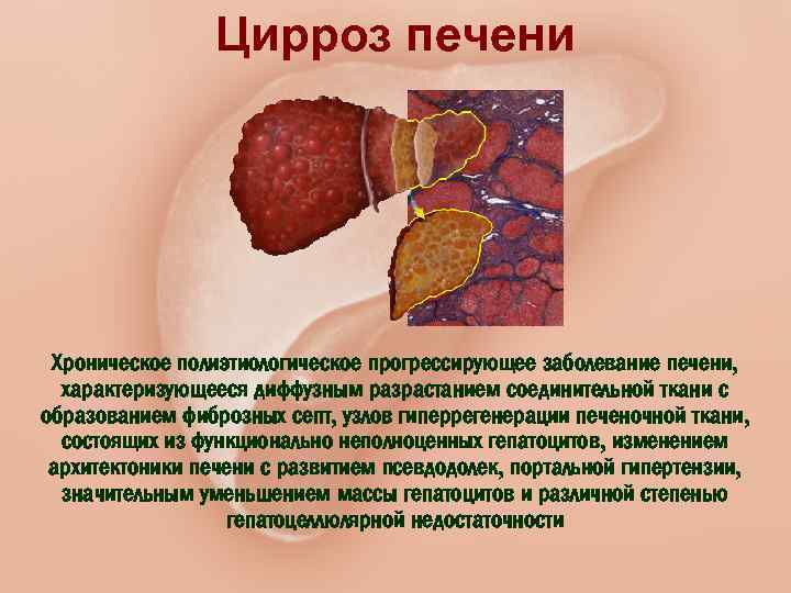 Цирроз печени Хроническое полиэтиологическое прогрессирующее заболевание печени, характеризующееся диффузным разрастанием соединительной ткани с образованием