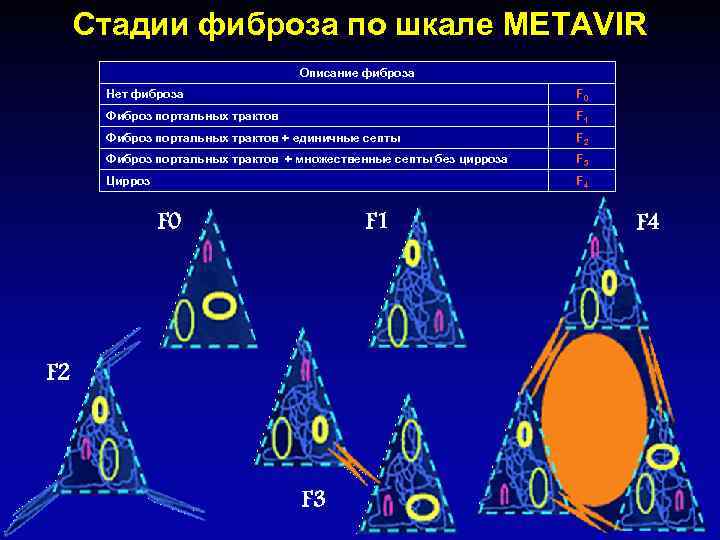 Стадии фиброза по шкале METAVIR Описание фиброза Нет фиброза F 0 Фиброз портальных трактов