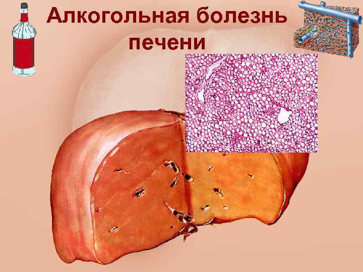 Алкогольная болезнь печени 