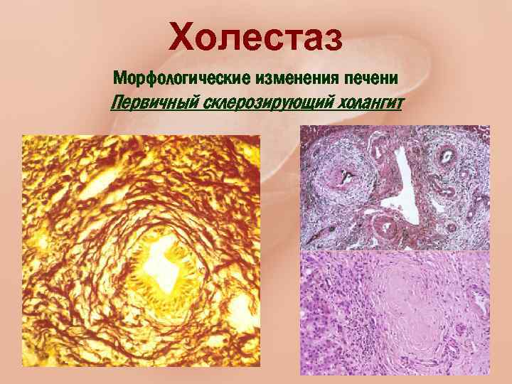 Холестаз Морфологические изменения печени Первичный склерозирующий холангит 