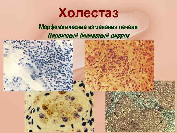 Холестаз Морфологические изменения печени Первичный билиарный цирроз 