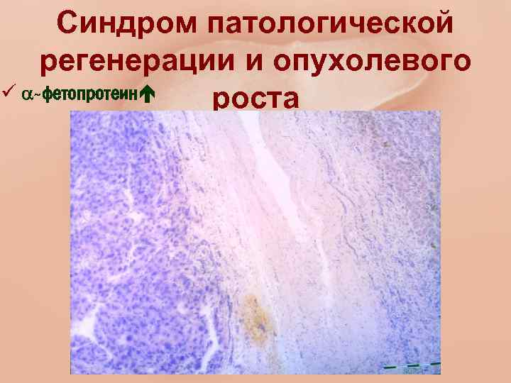 Синдром патологической регенерации и опухолевого ü -фетопротеин роста 