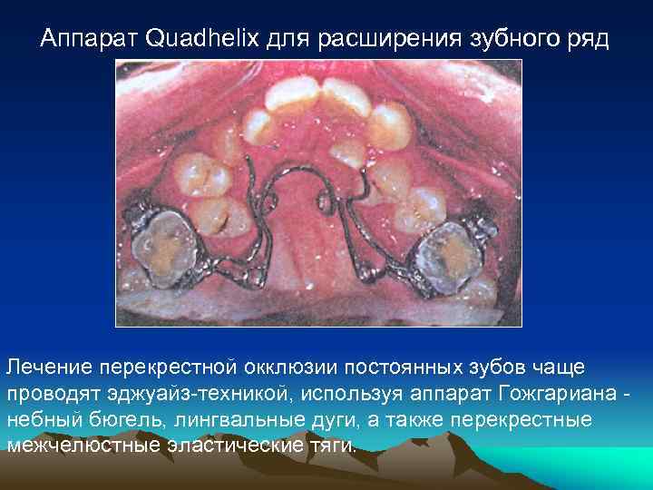 Аппарат Quadhelix для расширения зубного ряд Лечение перекрестной окклюзии постоянных зубов чаще проводят эджуайз-техникой,