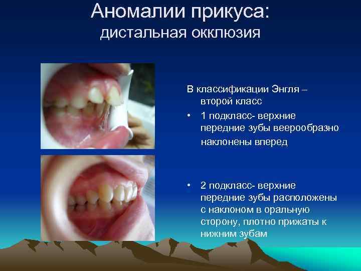 Аномалии прикуса: дистальная окклюзия В классификации Энгля – второй класс • 1 подкласс- верхние