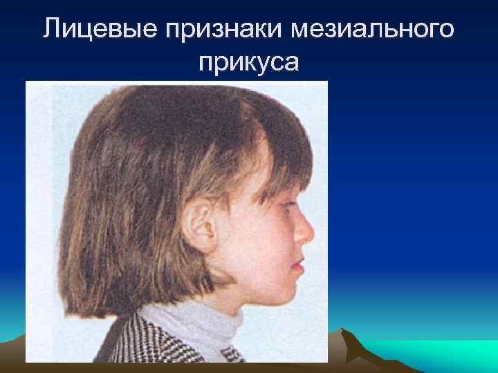 Лицевые признаки мезиального прикуса 