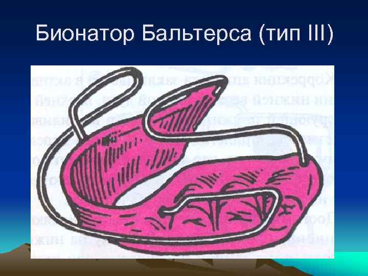 Бионатор Бальтерса (тип III) 
