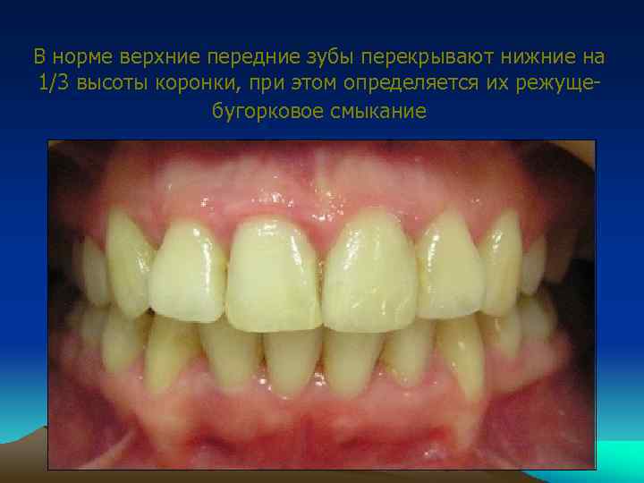 В норме верхние передние зубы перекрывают нижние на 1/3 высоты коронки, при этом определяется