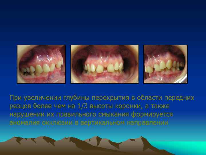 При увеличении глубины перекрытия в области передних резцов более чем на 1/3 высоты коронки,