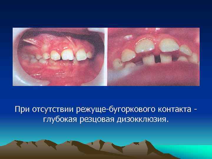 При отсутствии режуще-бугоркового контакта глубокая резцовая дизокклюзия. 