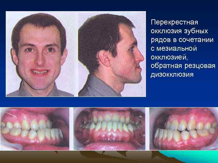Перекрестная окклюзия зубных рядов в сочетании с мезиальной окклюзией, обратная резцовая дизокклюзия 