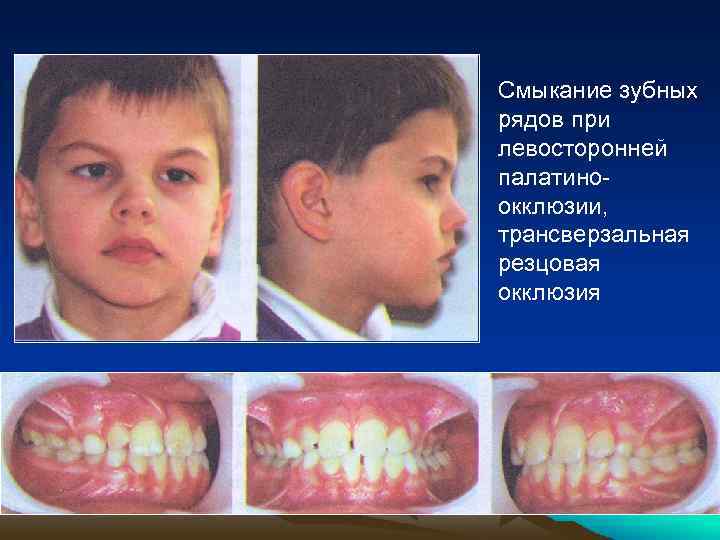 Смыкание зубных рядов при левосторонней палатиноокклюзии, трансверзальная резцовая окклюзия 