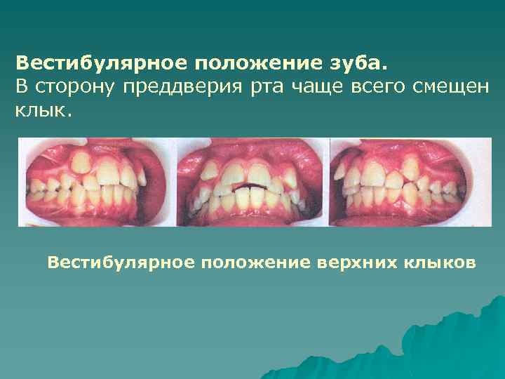 Вестибулярное положение зуба. В сторону преддверия рта чаще всего смещен клык. Вестибулярное положение верхних