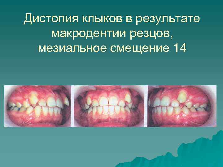 Дистопия клыков в результате макродентии резцов, мезиальное смещение 14 