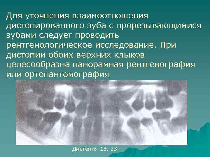 Для уточнения взаимоотношения дистопированного зуба с прорезывающимися зубами следует проводить рентгенологическое исследование. При дистопии