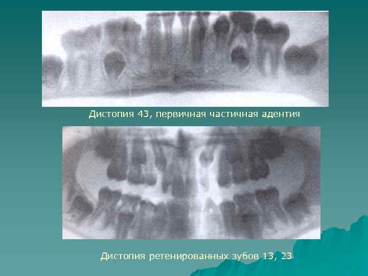 Дистопия 43, первичная частичная адентия Дистопия ретенированных зубов 13, 23 