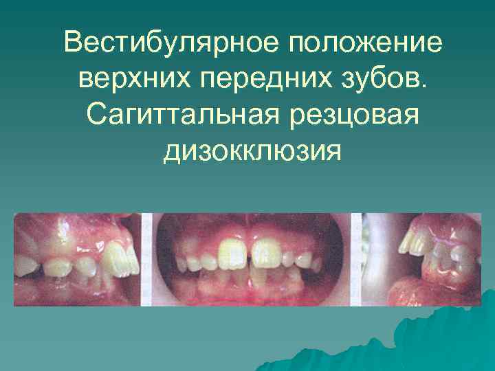 Вестибулярное положение верхних передних зубов. Сагиттальная резцовая дизокклюзия 