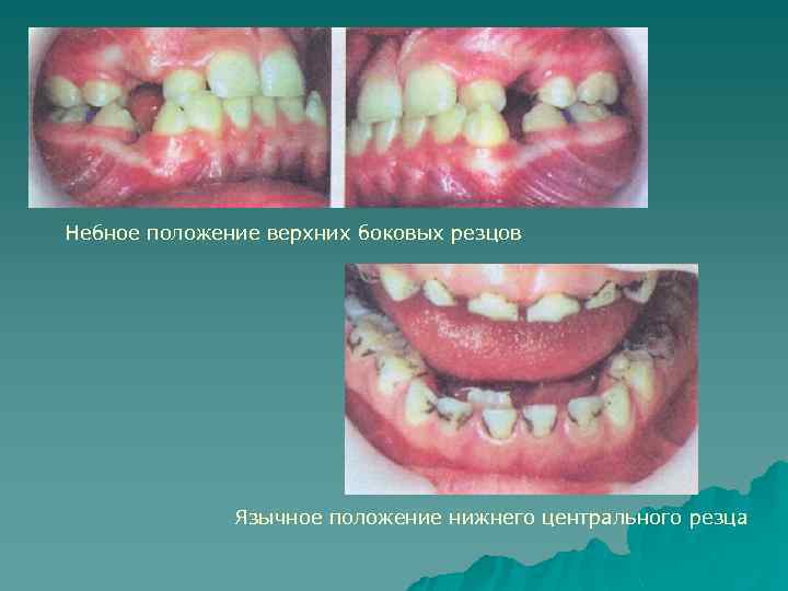 Небное положение верхних боковых резцов Язычное положение нижнего центрального резца 