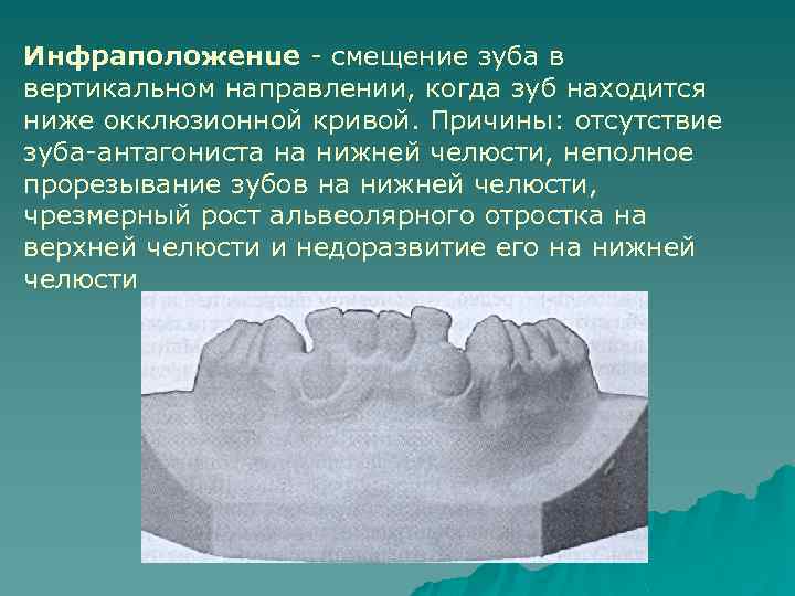 Инфраположенuе - смещение зуба в вертикальном направлении, когда зуб находится ниже окклюзионной кривой. Причины: