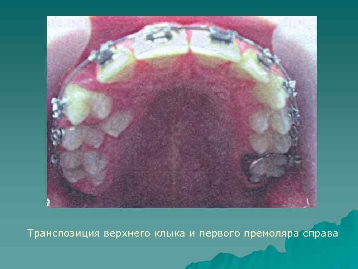 Транспозиция верхнего клыка и первого премоляра справа 