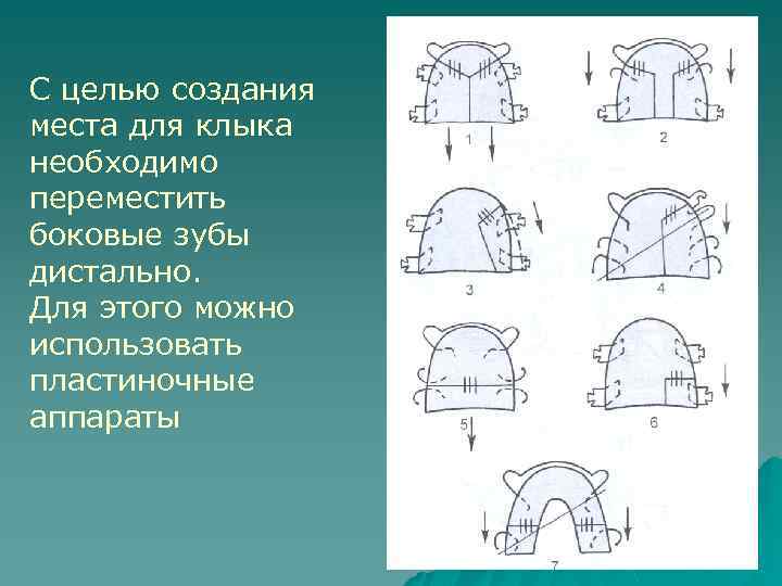 С целью создания места для клыка необходимо переместить боковые зубы дистально. Для этого можно