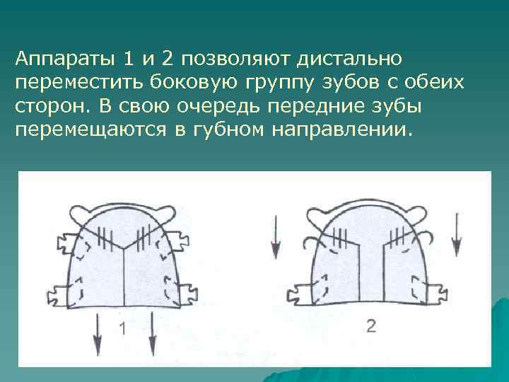 Аппараты 1 и 2 позволяют дистально переместить боковую группу зубов с обеих сторон. В