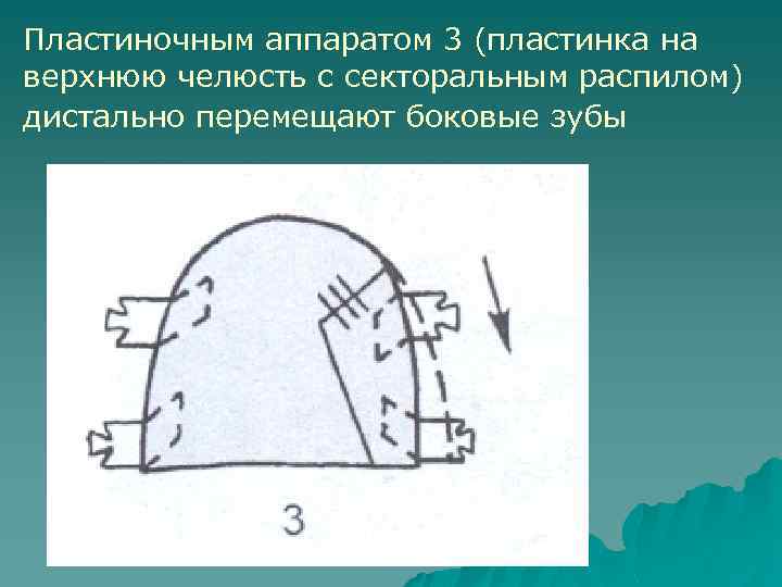 Пластиночным аппаратом 3 (пластинка на верхнюю челюсть с секторальным распилом) дистально перемещают боковые зубы