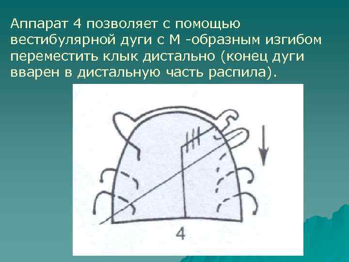 Аппарат 4 позволяет с помощью вестибулярной дуги с М -образным изгибом переместить клык дистально