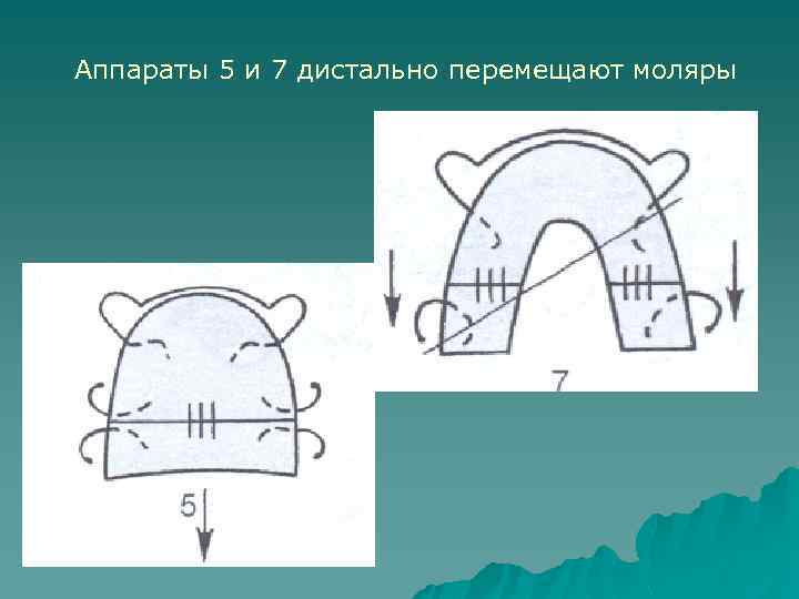 Аппараты 5 и 7 дистально перемещают моляры 