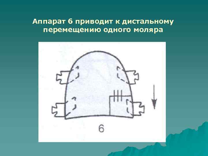 Аппарат 6 приводит к дистальному перемещению одного моляра 