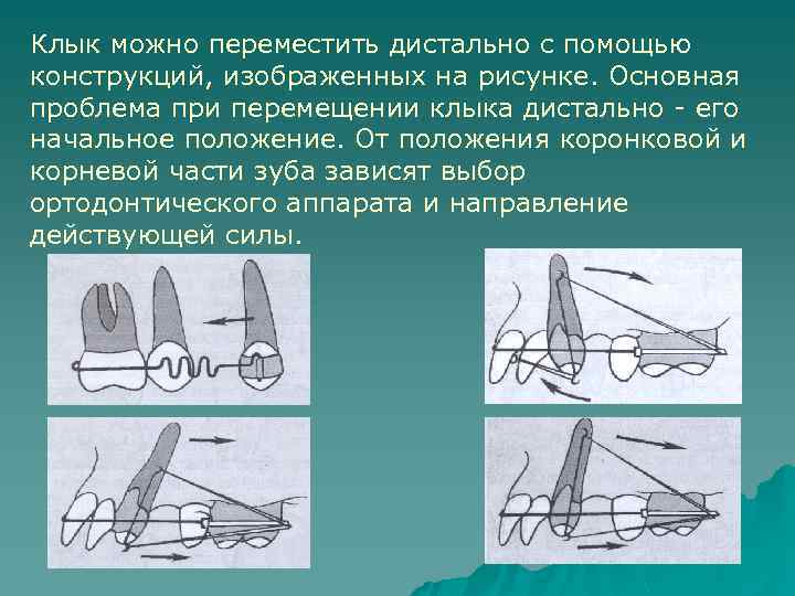 Клык можно переместить дистально с помощью конструкций, изображенных на рисунке. Основная проблема при перемещении