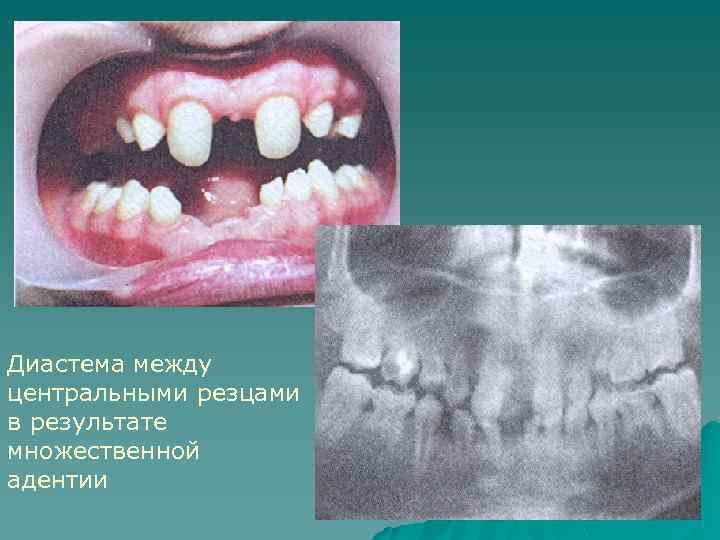 Диастема между центральными резцами в результате множественной адентии 