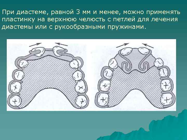При диастеме, равной 3 мм и менее, можно применять пластинку на верхнюю челюсть с