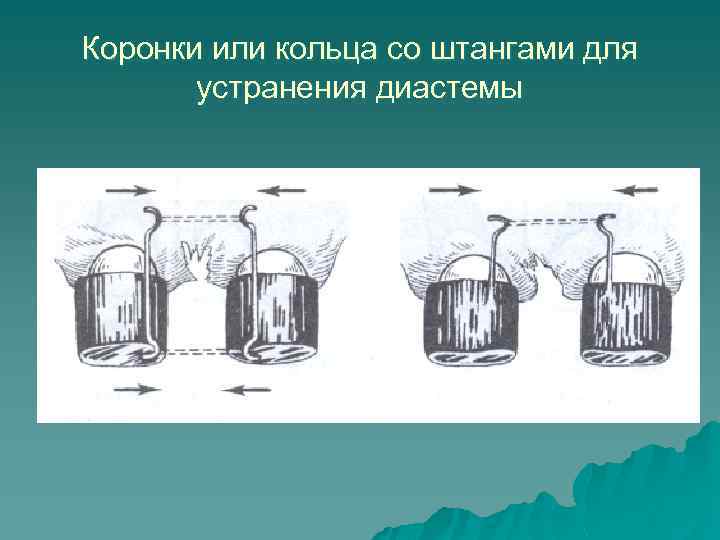 Коронки или кольца со штангами для устранения диастемы 