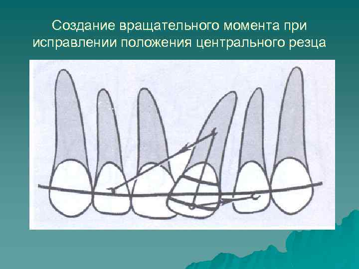Создание вращательного момента при исправлении положения центрального резца 