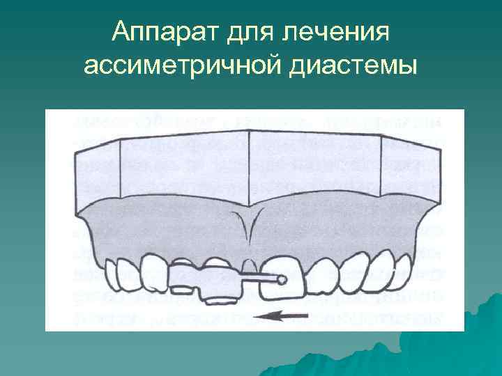 Аппарат для лечения ассиметричной диастемы 
