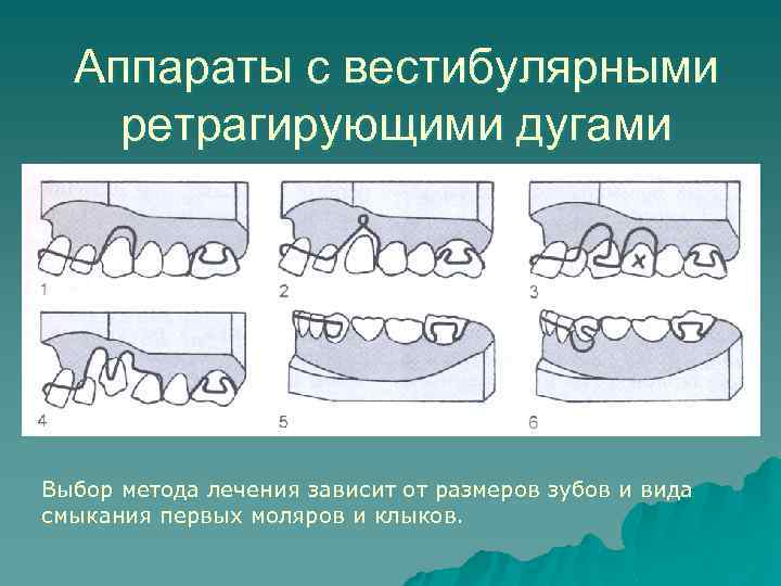 Аппараты с вестибулярными ретрагирующими дугами Выбор метода лечения зависит от размеров зубов и вида