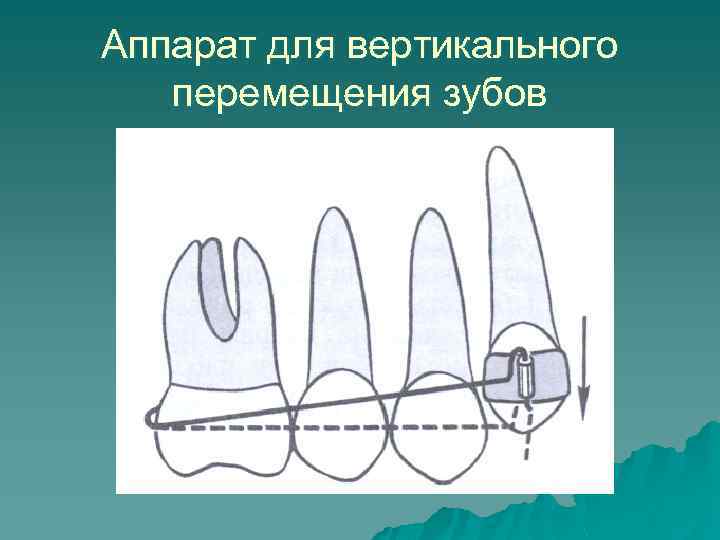 Аппарат для вертикального перемещения зубов 