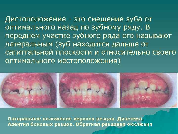 Дистоположение - это смещение зуба от оптимального назад по зубному ряду. В переднем участке