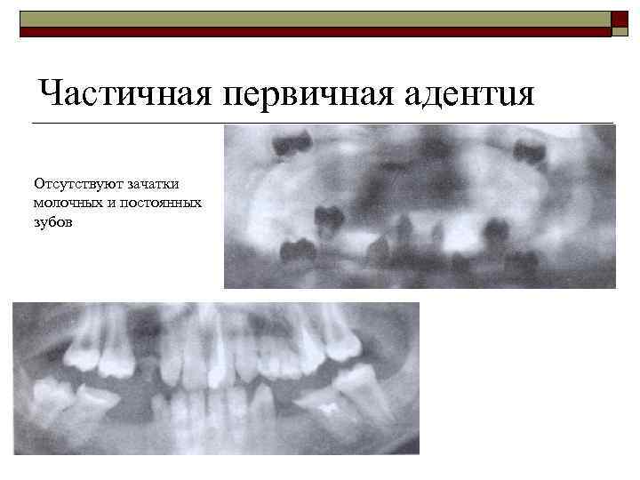 Частичная первичная адентuя Отсутствуют зачатки молочных и постоянных зубов 