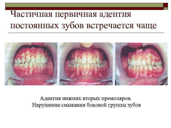 Частичная первичная адентия постоянных зубов встречается чаще Адентия нижних вторых премоляров. Нарушение смыкания боковой