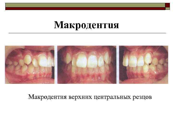 Макродентuя Макродентия верхних центральных резцов 