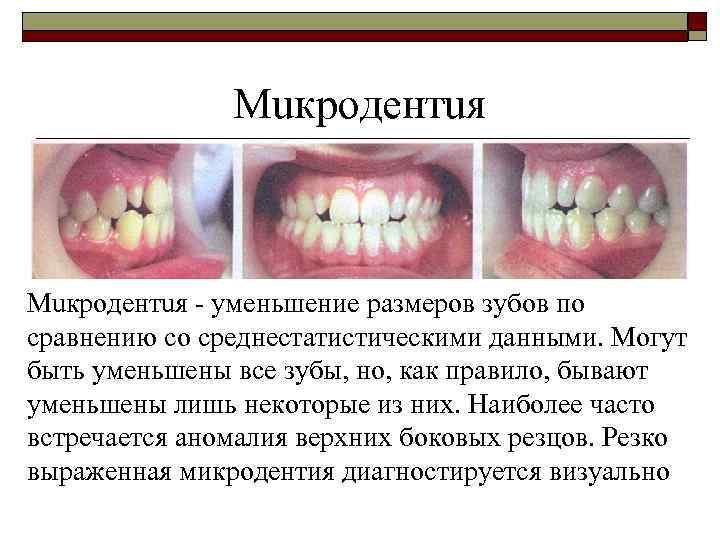 Мuкродентuя - уменьшение размеров зубов по сравнению со среднестатистическими данными. Могут быть уменьшены все