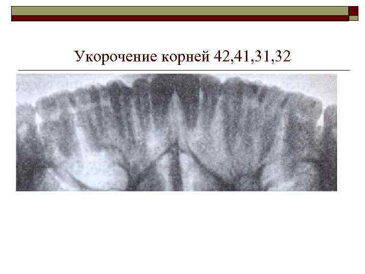 Укорочение корней 42, 41, 32 