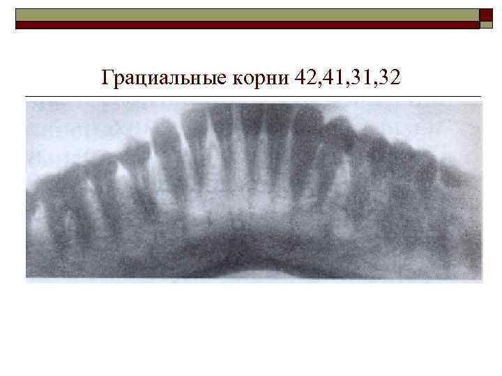 Грациальные корни 42, 41, 32 