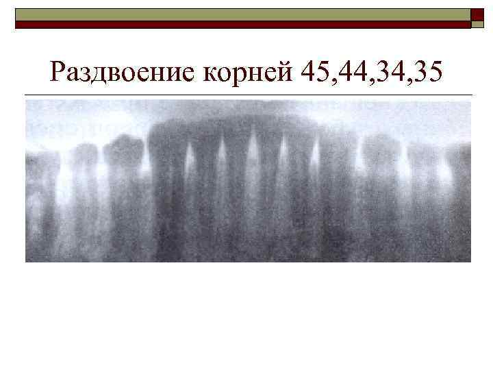 Раздвоение корней 45, 44, 35 