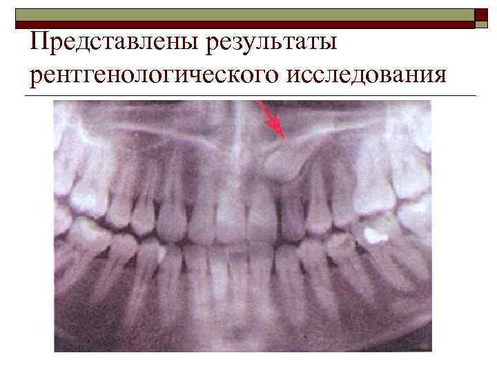 Представлены результаты рентгенологического исследования 