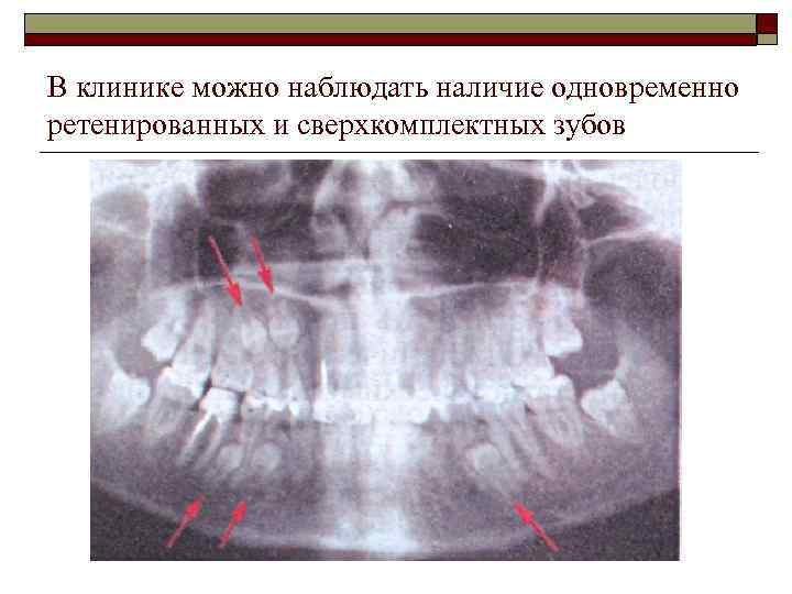 В клинике можно наблюдать наличие одновременно ретенированных и сверхкомплектных зубов 