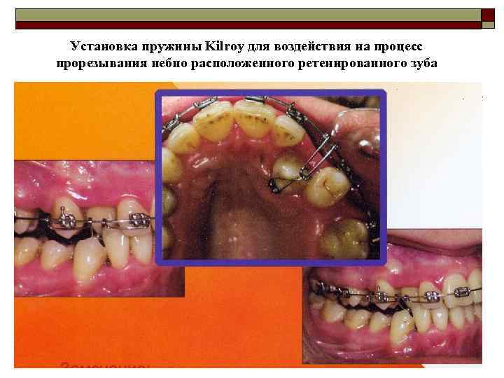 Установка пружины Kilroy для воздействия на процесс прорезывания небно расположенного ретенированного зуба 