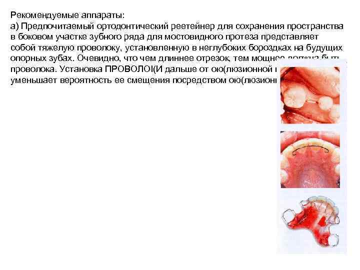 Рекомендуемые аппараты: а) Предпочитаемый ортодонтический реетейнер для сохранения пространства в боковом участке зубного ряда